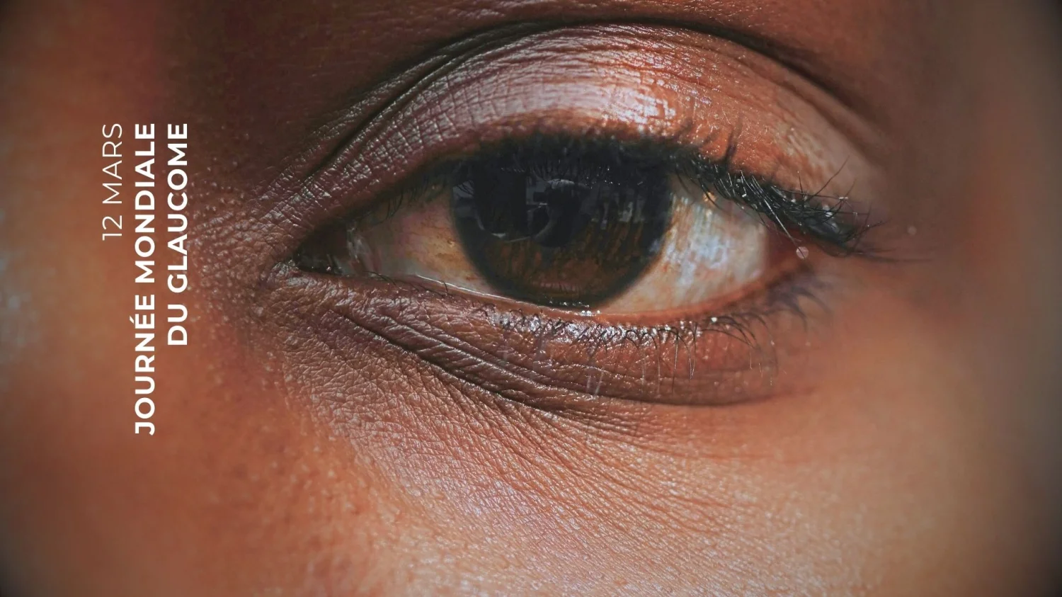 Le glaucome : Voir venir pour mieux agir